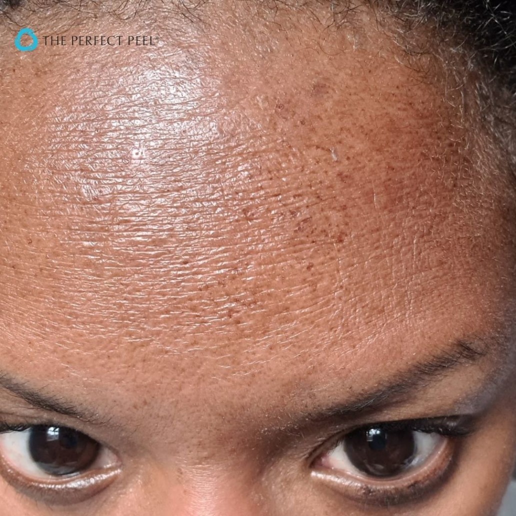The Perfect Peel&reg; Day 2