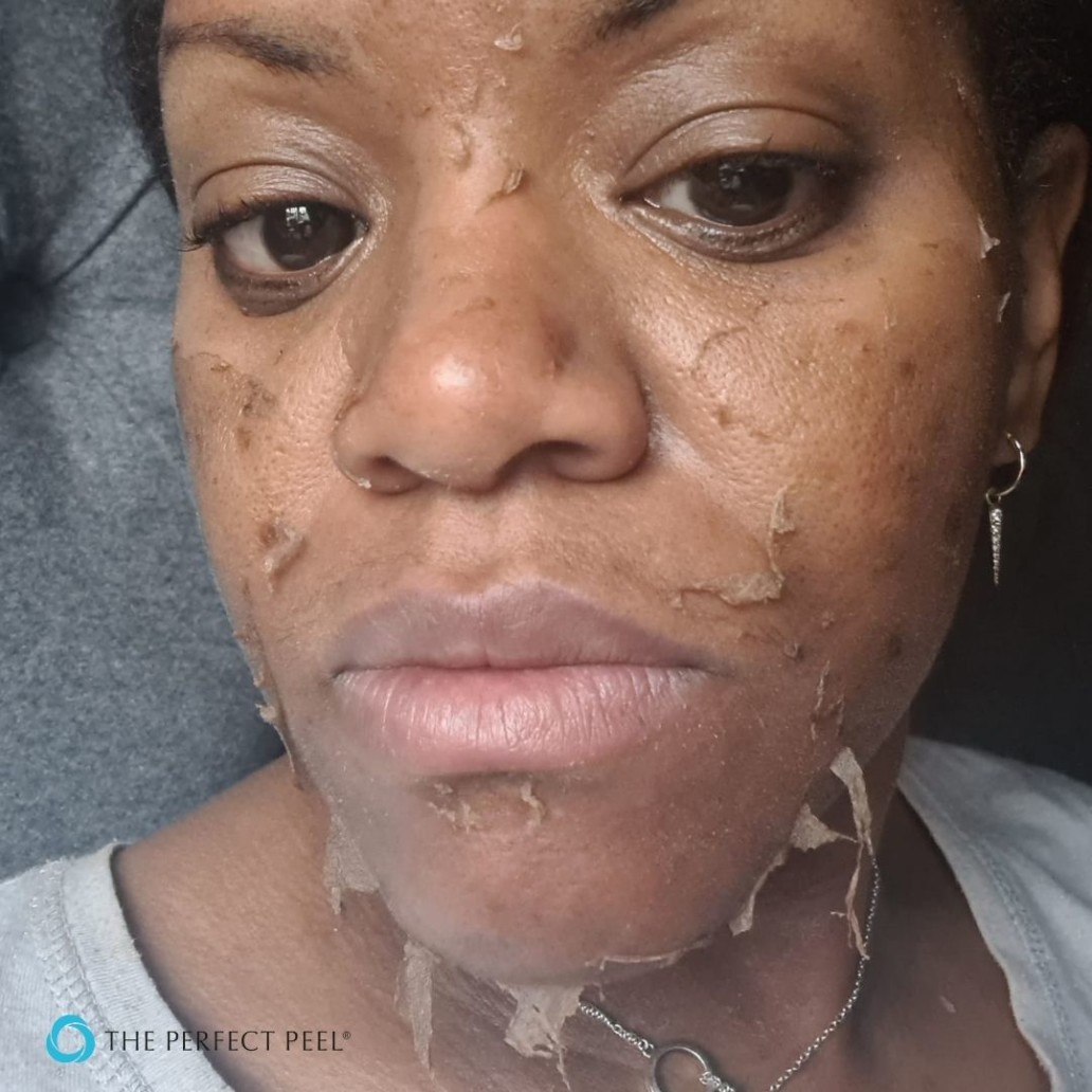 The Perfect Peel&reg; Shedding