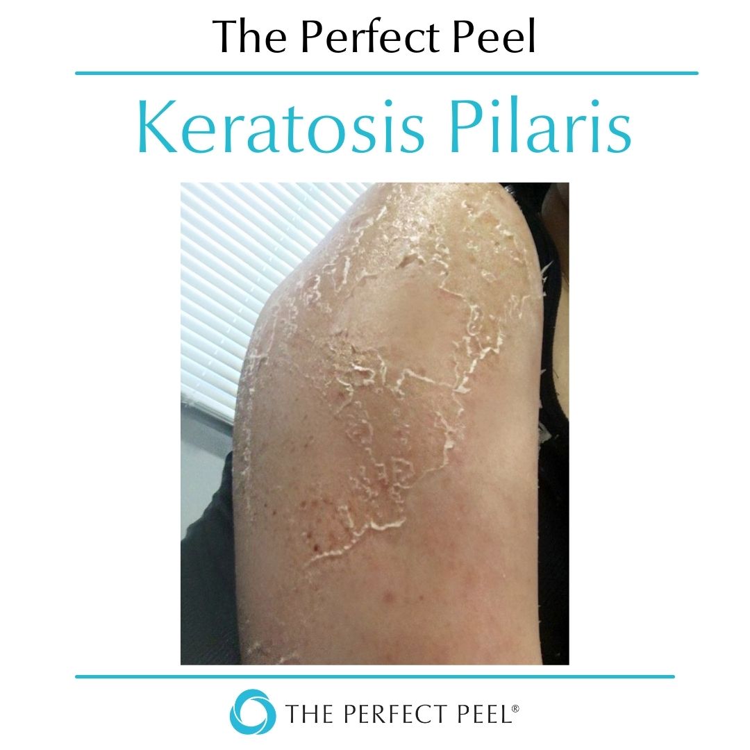 Treating Keratosis Pilaris
