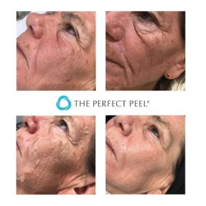 The Perfect Peel Before & After