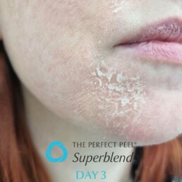 The Perfect Peel® Superblend Day 3