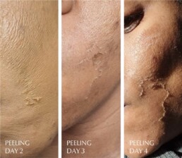 The Perfect Peel® Superblend Days 1- 4