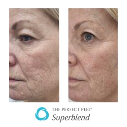 The Perfect Peel® Superblend before and after